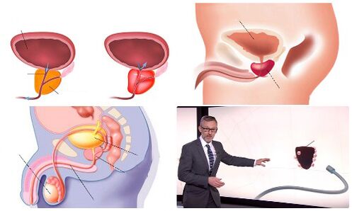 zdrava in bolna prostata