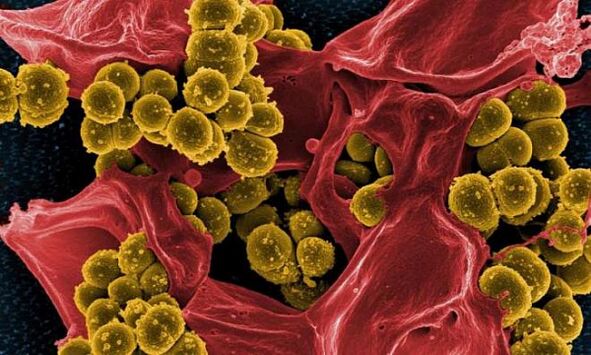 Staphylococcus aureus kot vzrok bakterijskega prostatitisa
